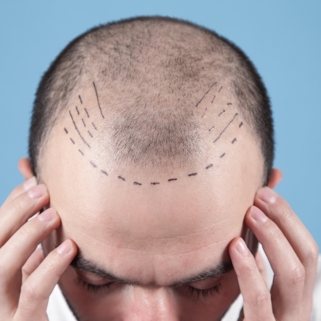 Hair Transplant (Grafts)